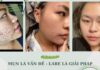 Bí quyết phục hồi làn da hư tổn do mụn cho chị em phụ nữ